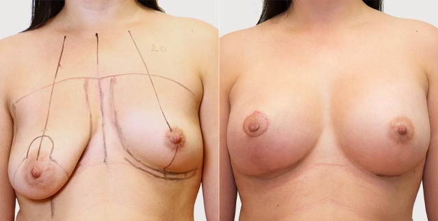 Zvětšení prsou foto před a po